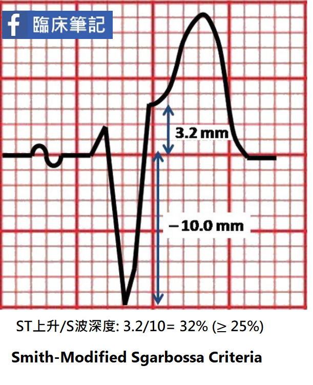 LBBB患者的心肌梗塞心電圖